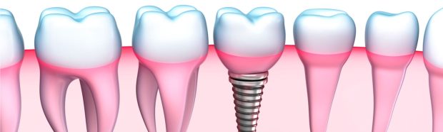 dental-implants-banner-e1472002475674